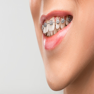 How to Choose the Best Orthodontist in Dubai?