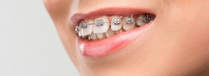 The Road to a Beautiful Smile: How Braces Can Transform Your Life in Dubai